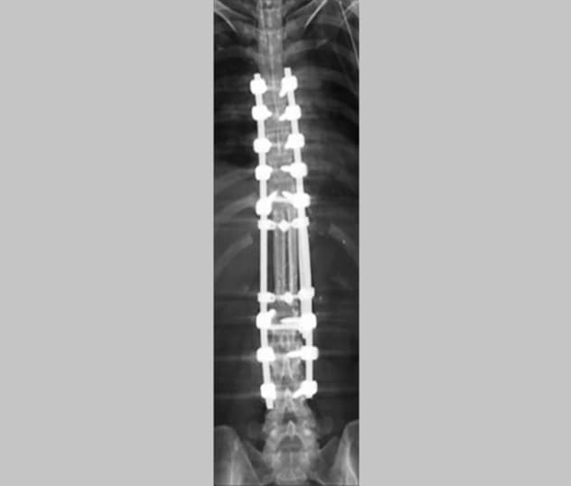 Rayos X de un injerto libre vascularizado de doble capa de peroné en reconstrucción vertebral