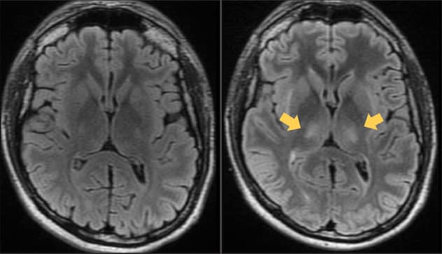 يُظهر التصوير بالرنين المغناطيسي دماغ رجل مصاب بلمفومة الخلايا البائية قبل العلاج بالخلايا التائية ذات مستقبلات المستضدات الخيمرية للخلايا التائية وبعده