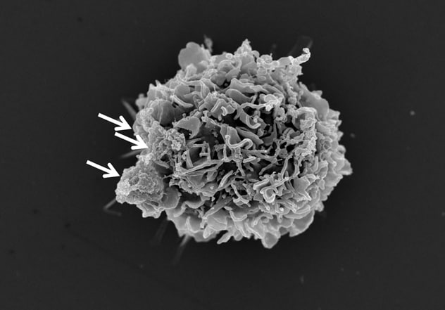 Vesículas extracelulares de glioblastoma que se unen al glóbulo blanco