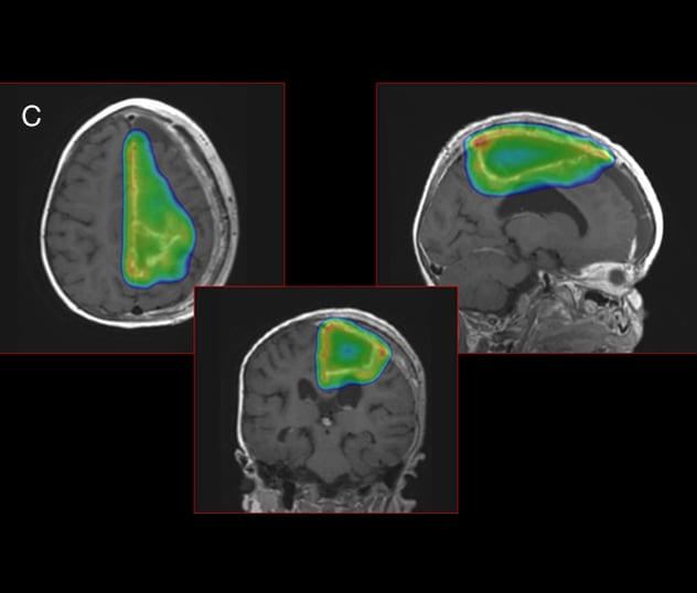 La terapia de rayos de protones se utiliza para evitar la toxicidad en el tejido cerebral circundante