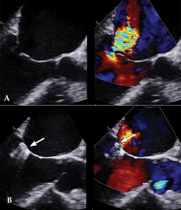 Mitral regurgitation before and after MitraClip placement