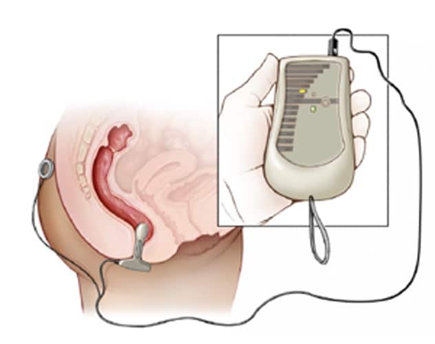 Un sensor de biorretroalimentación suave que se inserta en el conducto anal