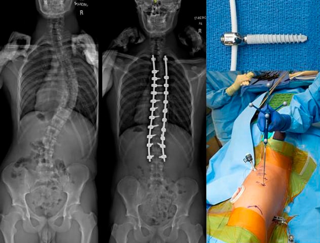 Fusion surgery results and vertebral body tethering