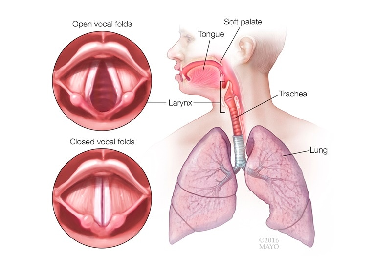 bilateral vocal cord paralysis