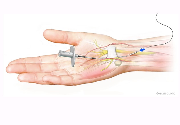 Carpal tunnel syndrome – What it is and what are the treatment options?