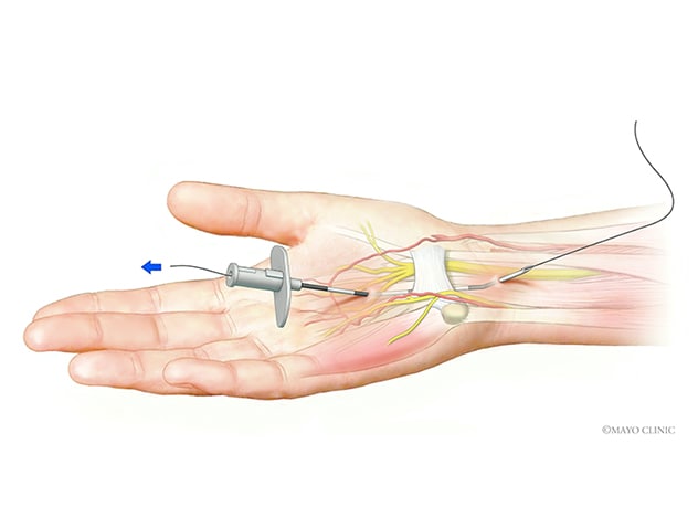 Carpal tunnel release