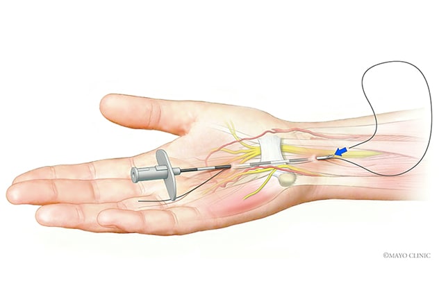 Carpal Tunnel Syndrome Treatment NYC · Sports Pain Management Clinic