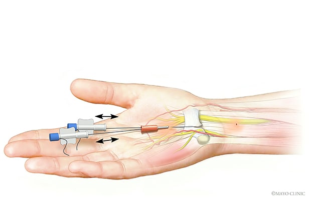 Incisionless, ultrasound-guided approach for carpal tunnel release
