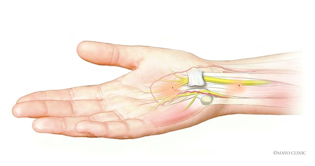 Bilateral (Both Wrists) Carpal Tunnel Syndrome Surgery: Upper Extremity  Specialists: Orthopedic Surgeons