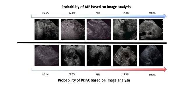Probabilidad de pancreatitis autoinmune y adenocarcinoma ductal pancreático basado en análisis de imágenes