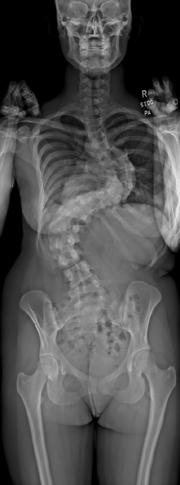 La radiografía preoperatoria muestra escoliosis