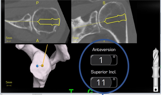Intraoperative guidance for shoulder arthroscopy