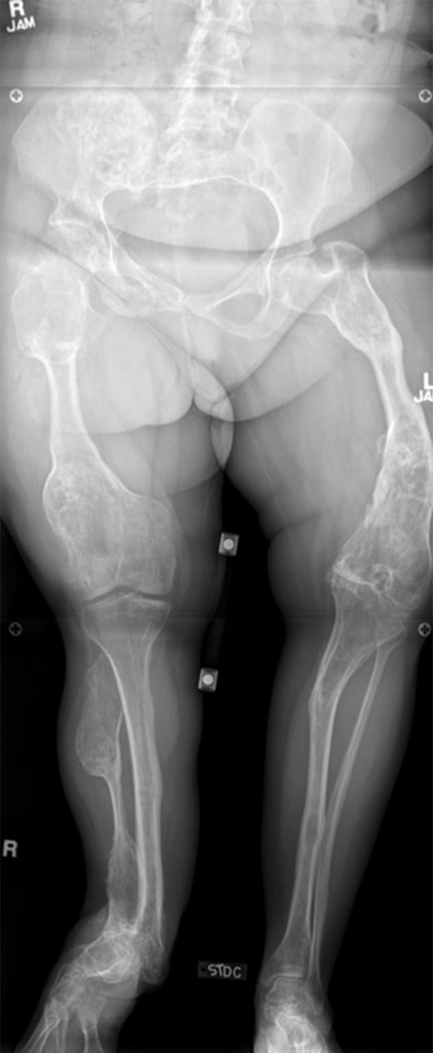 X-ray of a 55-year-old woman with Ollier's disease
