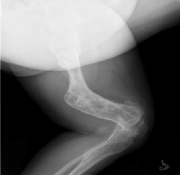 Radiografía de una mujer de 55 años con enfermedad de Ollier