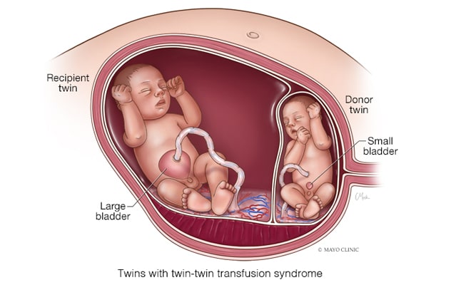 Síndrome de transfusión gemelo a gemelo