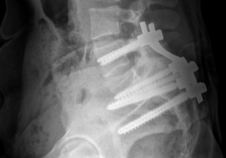 spondylolisthesis x ray