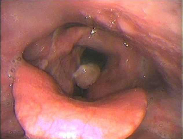 Laryngeal structures seen on rhinolaryngoscopy