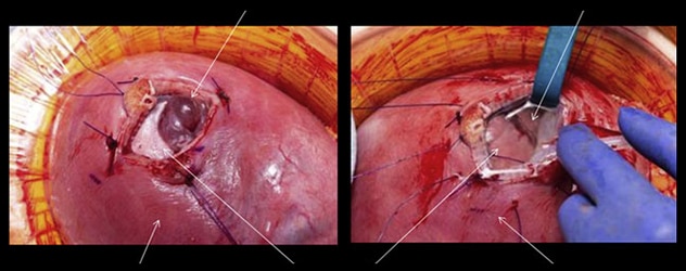 Reparación del mielomeningocele en el útero