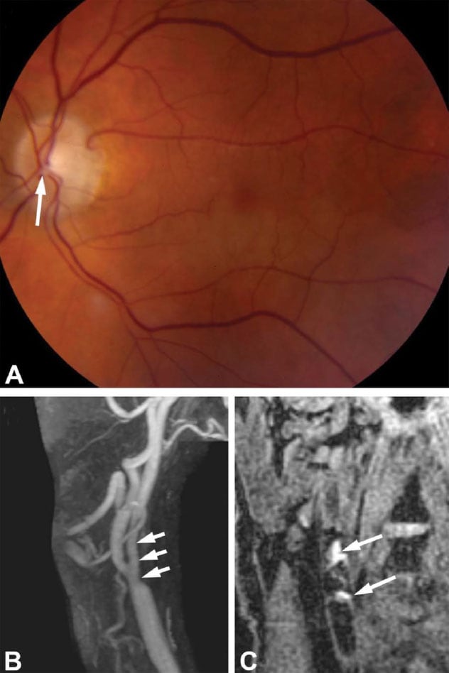 Oclusión arterial retiniana