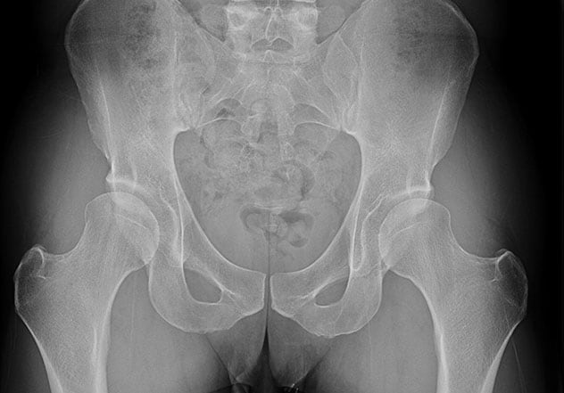 Combined hip dysplasia and impingement