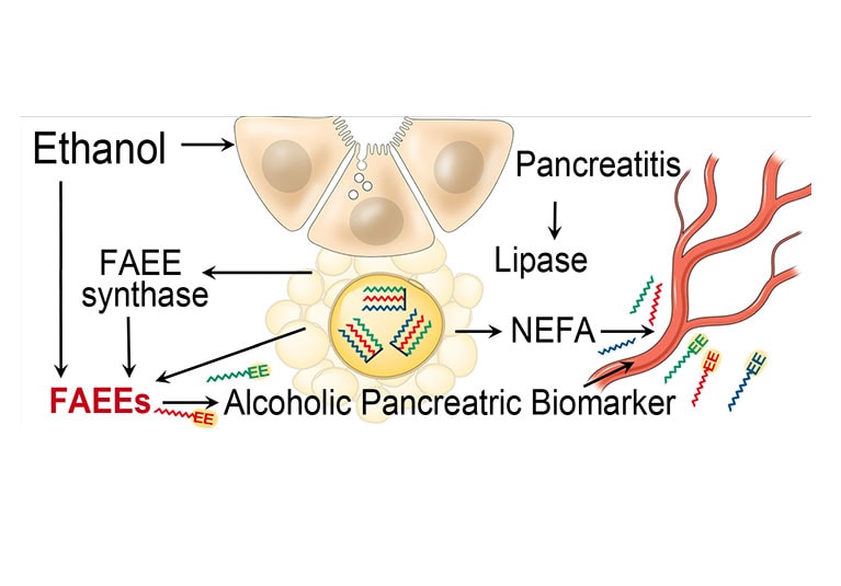 pancreatitis alcohol