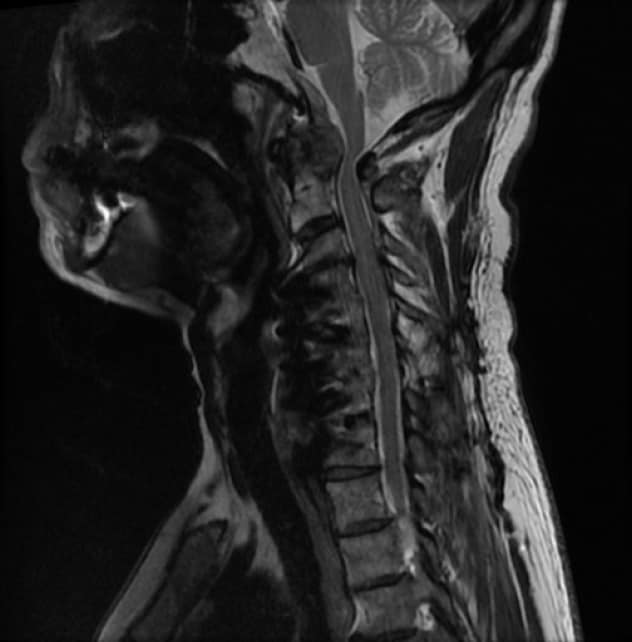 Compresión de la médula espinal