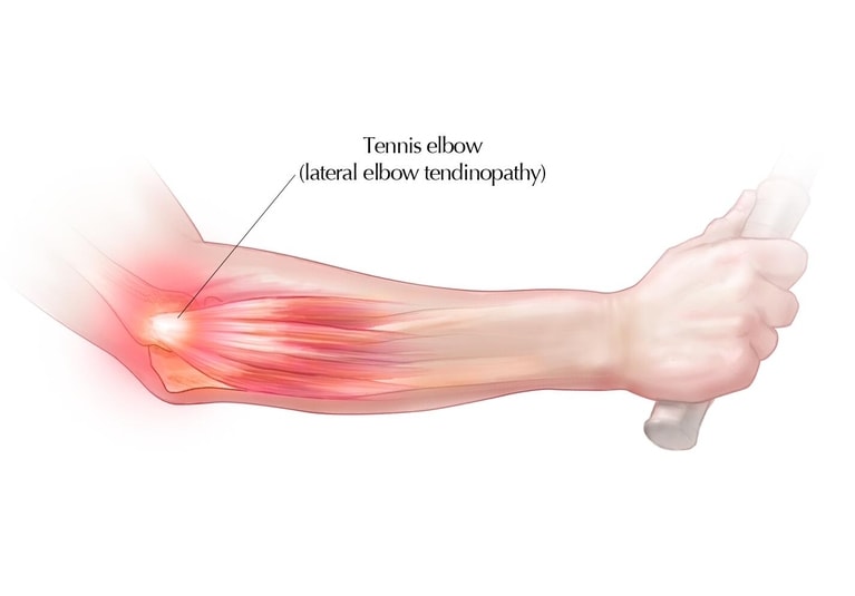 https://www.mayoclinic.org/-/media/kcms/gbs/medical-professionals/images/2022/01/31/19/01/tennis-elbow-767wx535h.jpg