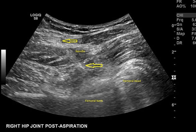 Ultrasound image of hip aspiration