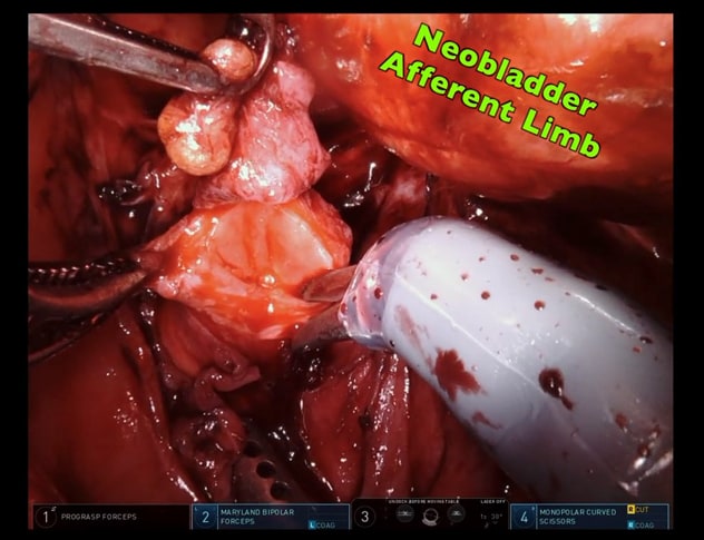 Revisión intraoperatoria de anastomosis uretero-entérica