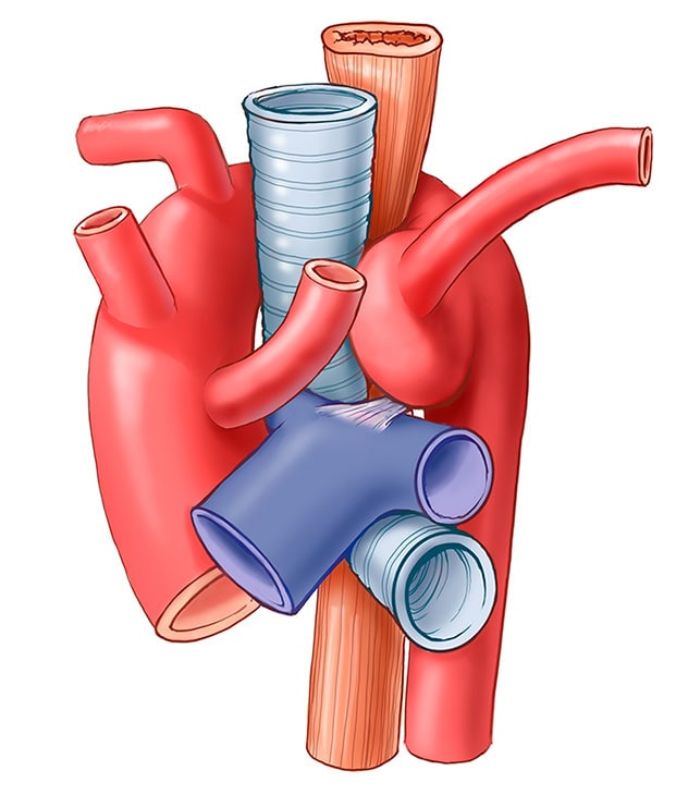 Right aortic arch with left ligamentum
