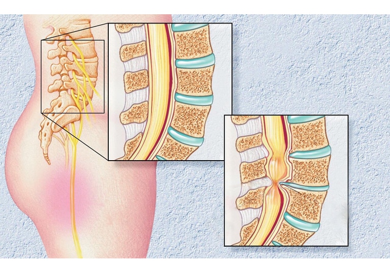 Spinal Stenosis: Lumbar