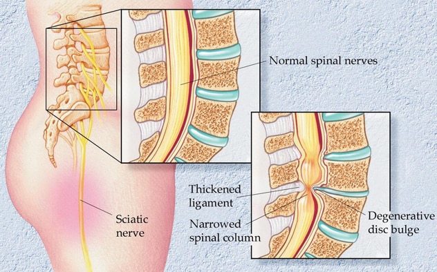 Herniated disk - Symptoms and causes - Mayo Clinic