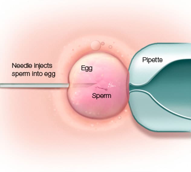 Intracytoplasmic sperm injection (ICSI)
