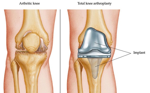 Implante de rodilla