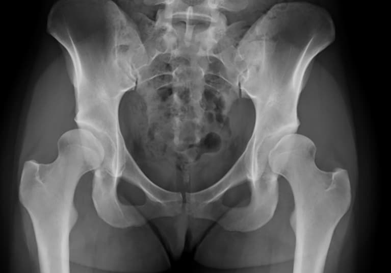 Anatomy of the Hip  Central Coast Orthopedic Medical Group