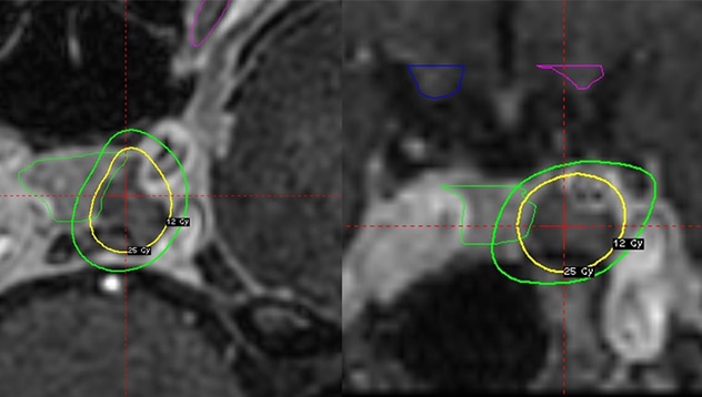 Axial and coronal MRI