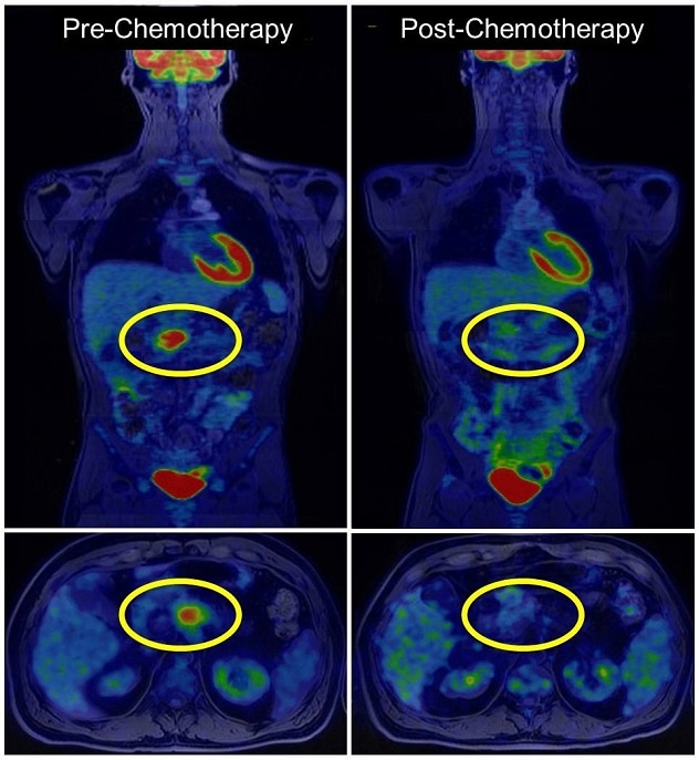 Exploración por tomografía por emisión de positrones para detectar cáncer de páncreas