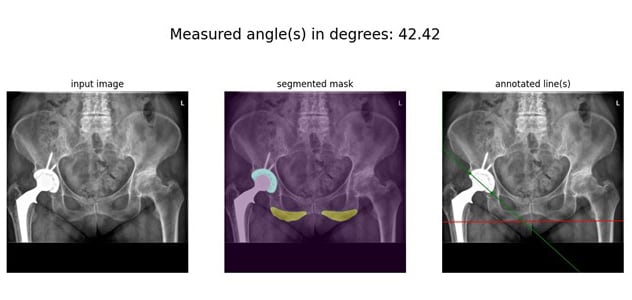 Un canal de aprendizaje profundo para medir los ángulos de inclinación acetabular