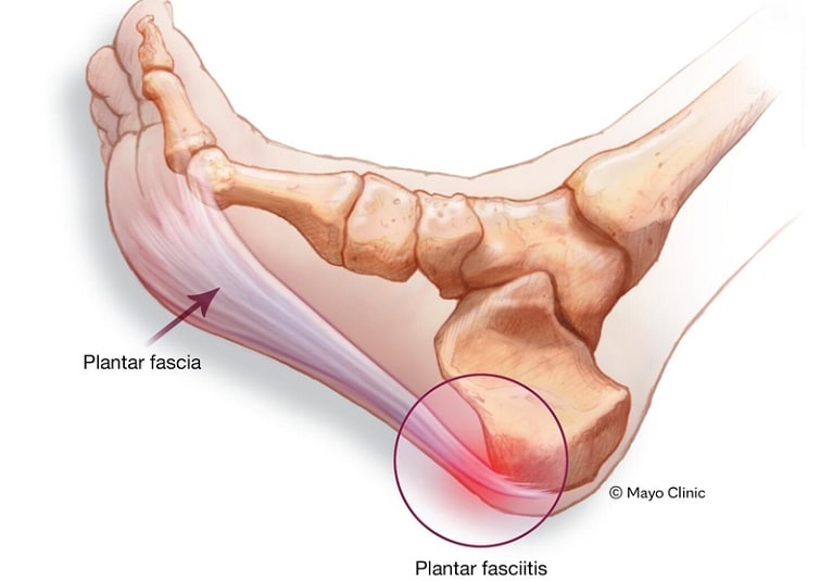 Overload Heel Pain Syndrome - FootEducation