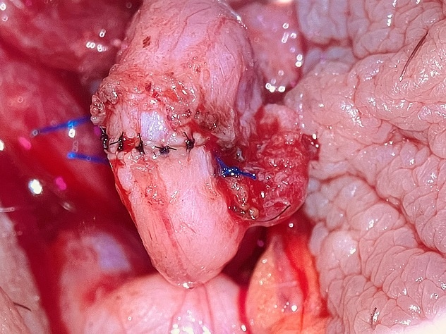 Vasectomy reversal procedure