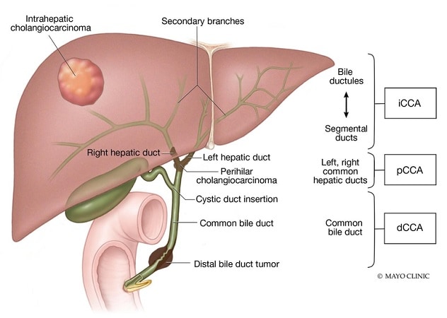 胆管癌分类