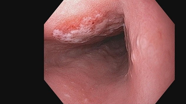 Imagen previa al procedimiento que muestra un adenocarcinoma esofágico