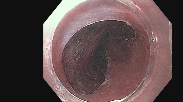 Post-procedure image of the esophagus