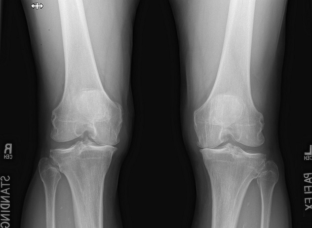 Preoperative image of the knees of a patient who had a partial knee replacement