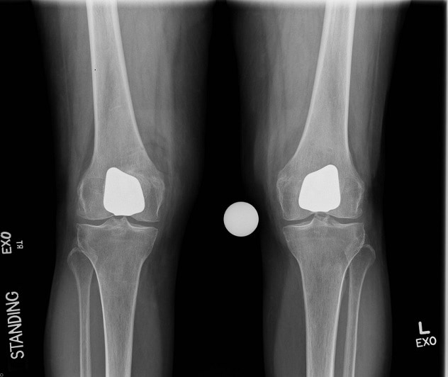Postoperative image of the knees of a patient who had a partial knee replacement