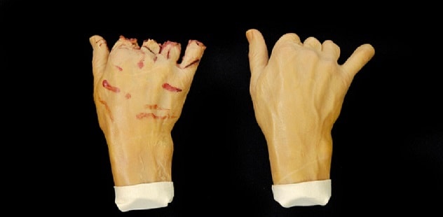 Dedos lesionados