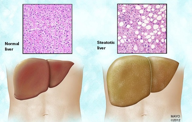 脂肪变性肝脏中的脂肪堆积