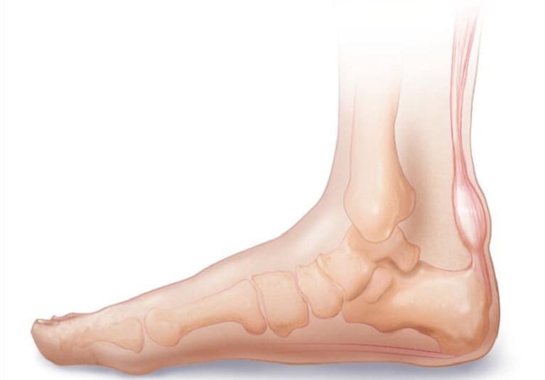 What's Achilles Tendonitis & Its Causes? - Upswing Health