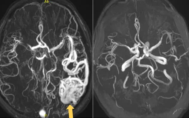 AVMs: Multimodal approach for individualized treatment - Mayo Clinic