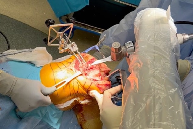 Cirugía robótica para artroplastia total de rodilla